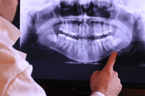Best Emergency Wisdom Teeth Removal in Guymon, OK